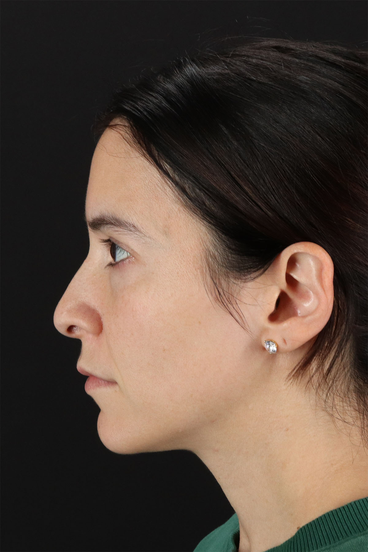CO2 Laser Before & After Patient #11103