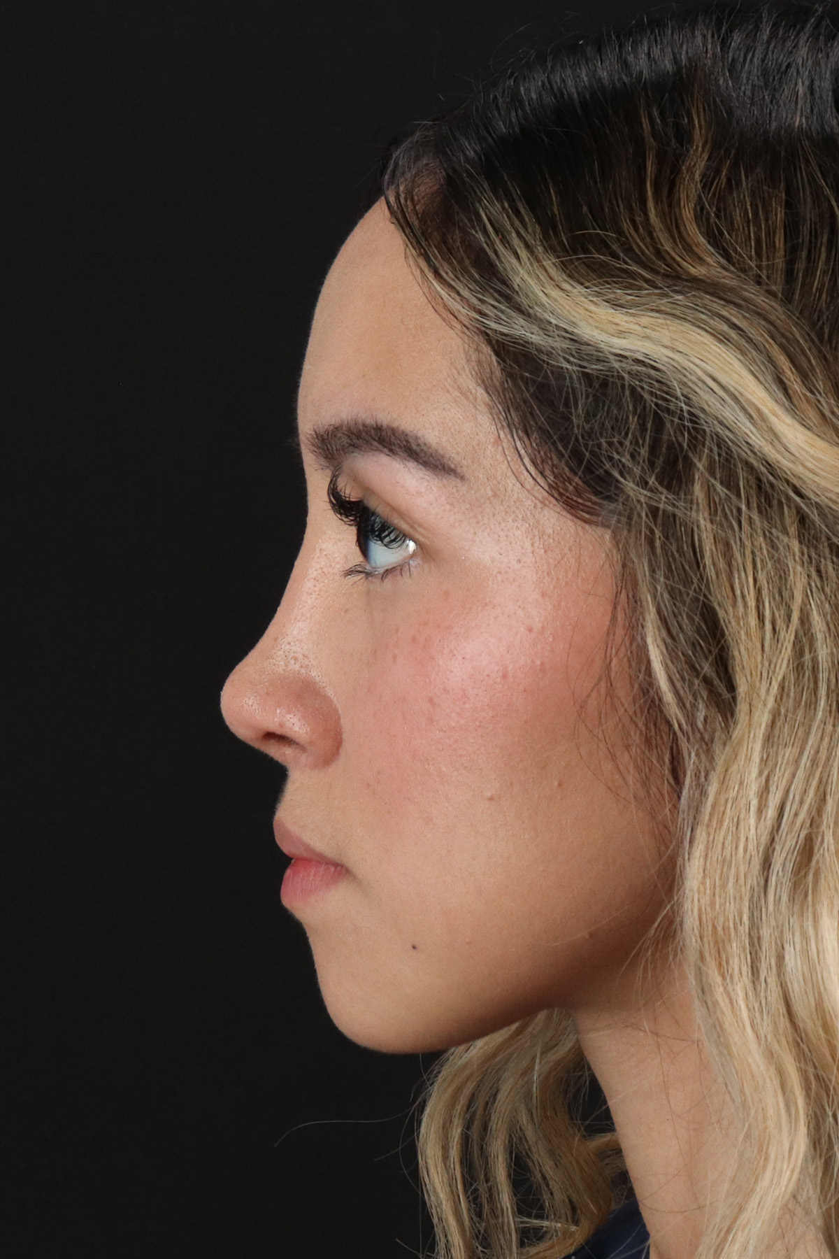 Rhinoplasty Before & After Patient #12216