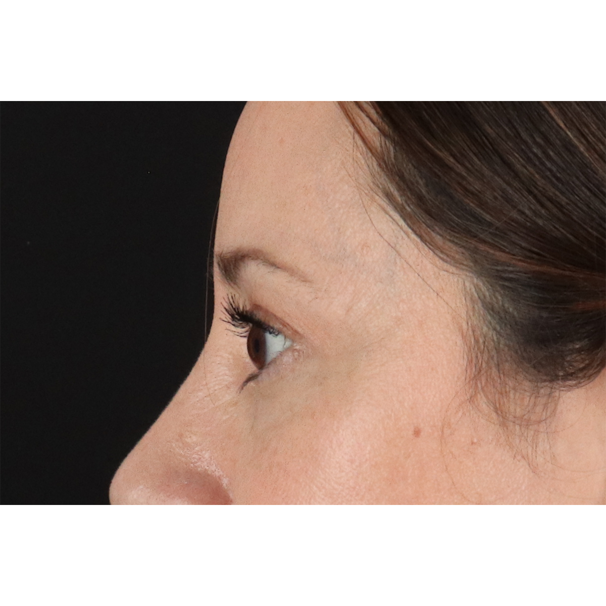 Blepharoplasty (Eyelid Surgery) Before & After Patient #11114