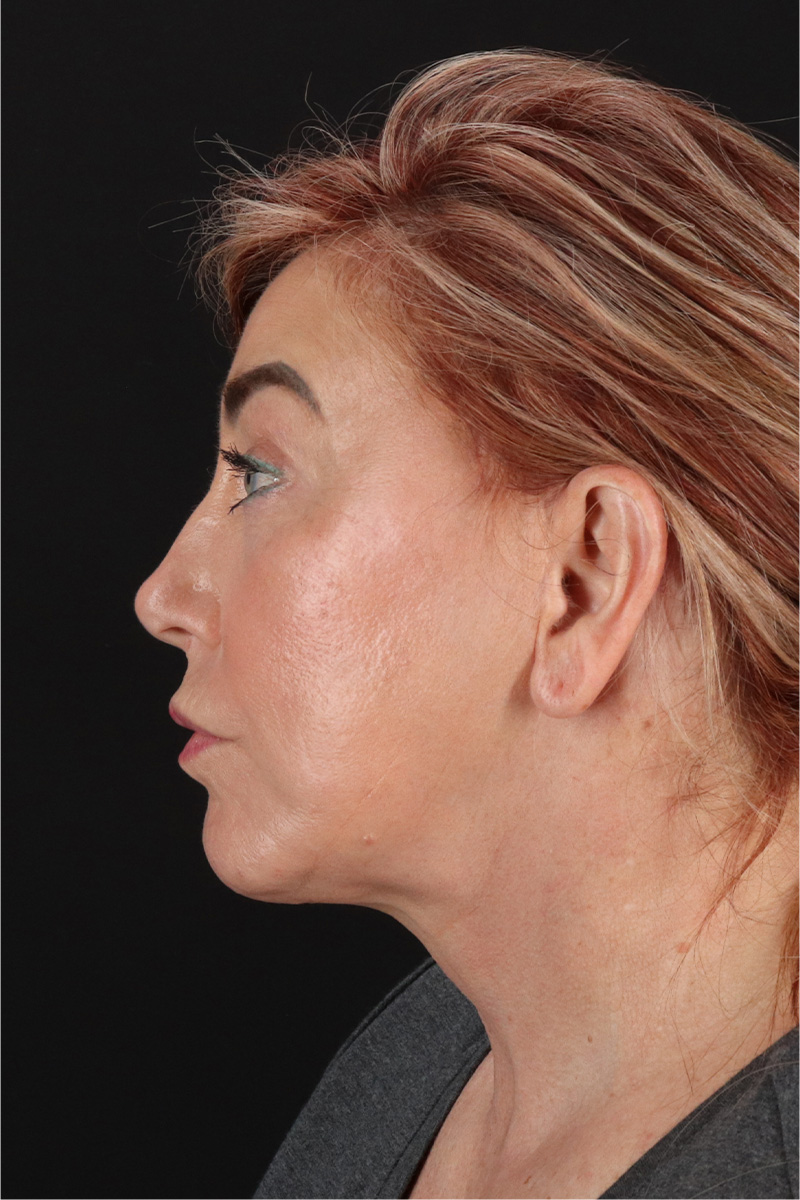 Fat Grafting To The Face Before & After Patient #11828
