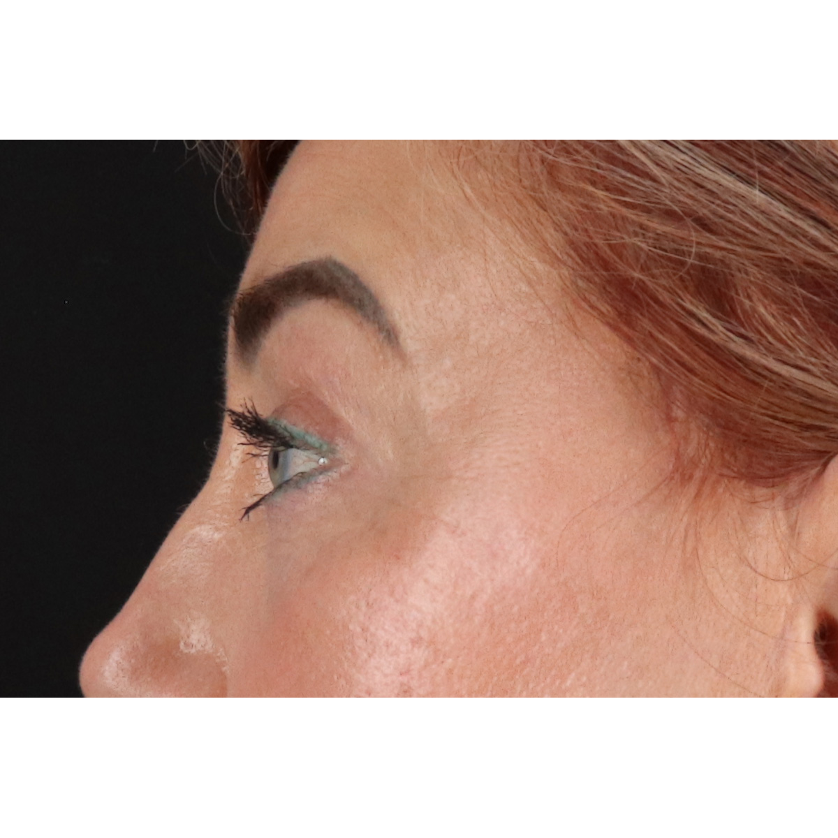Blepharoplasty (Eyelid Surgery) Before & After Patient #11506