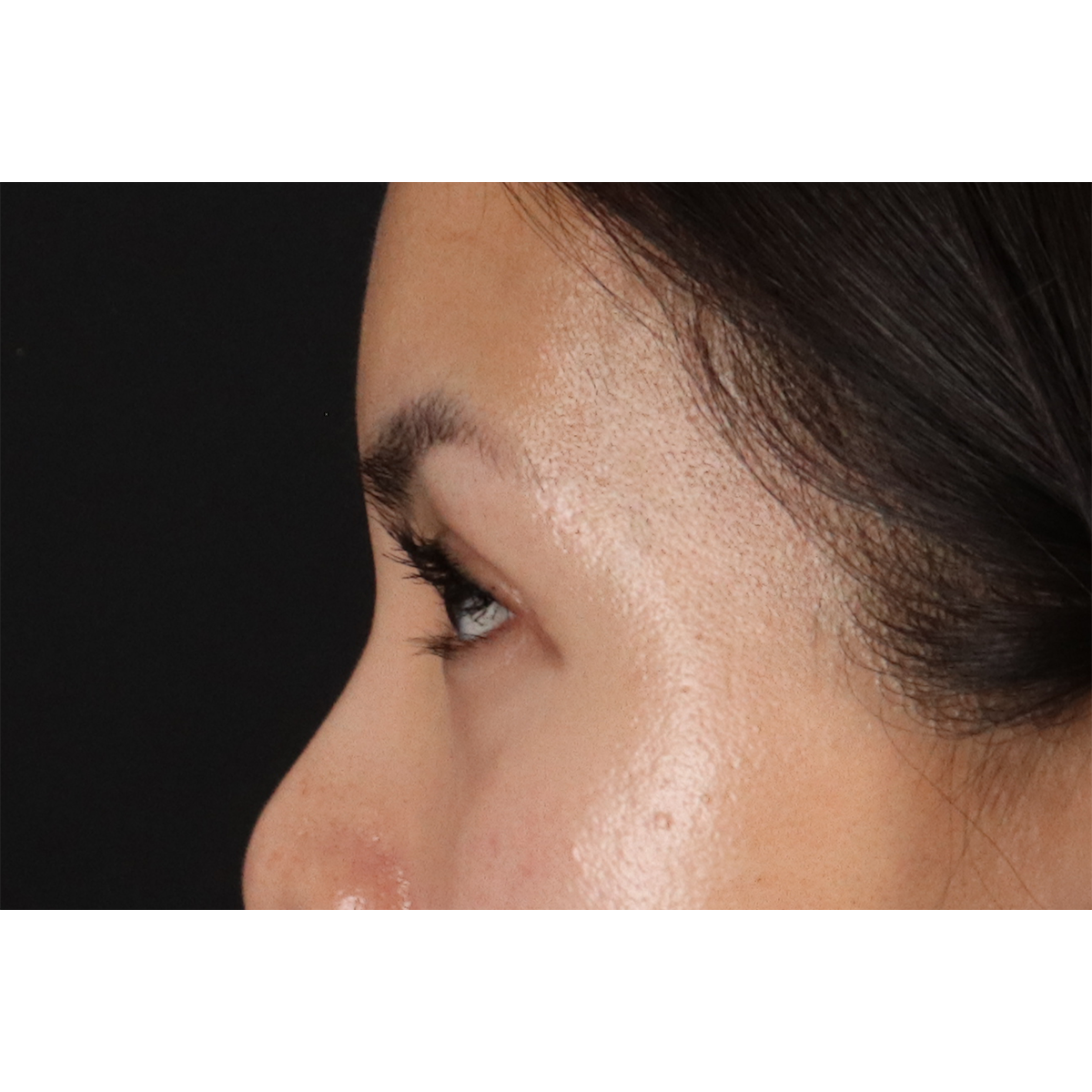 Blepharoplasty (Eyelid Surgery) Before & After Patient #10782