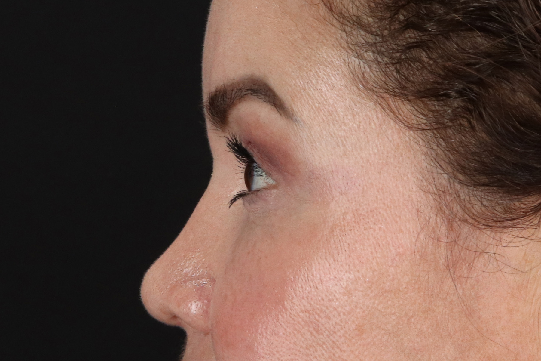 Rhinoplasty Before & After Patient #12656