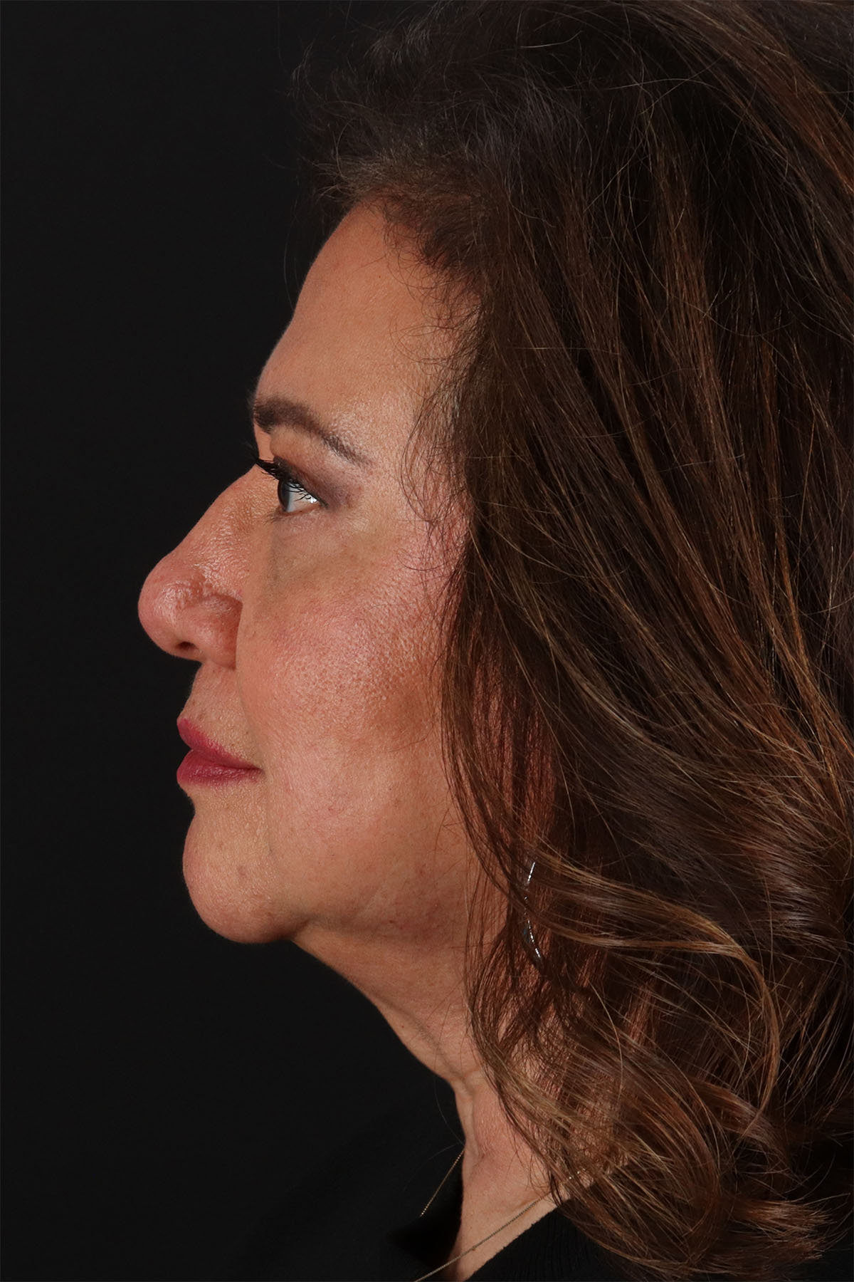 CO2 Laser Before & After Patient #11136