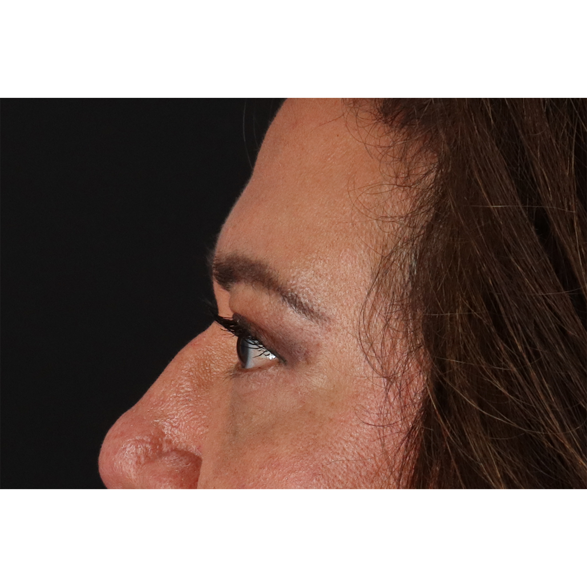 Blepharoplasty (Eyelid Surgery) Before & After Patient #11125