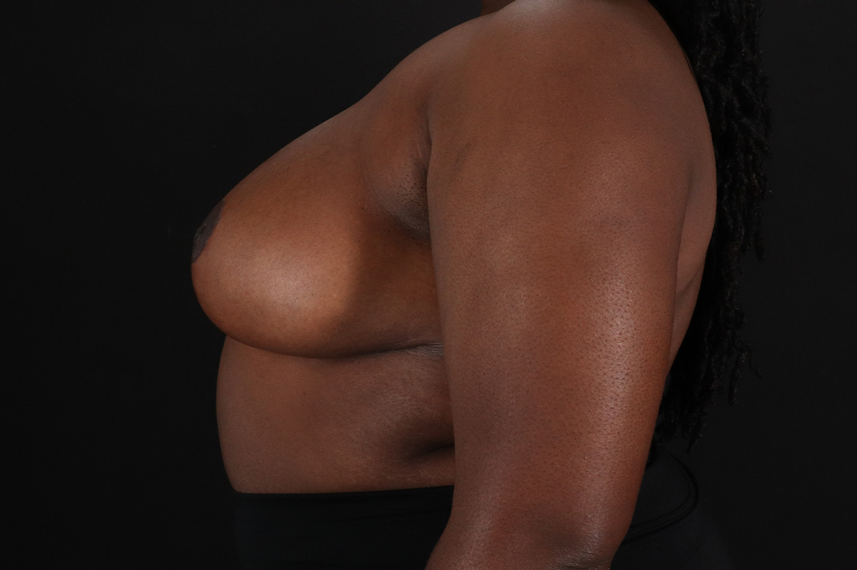 Breast Reduction With Lift Before & After Patient #11484
