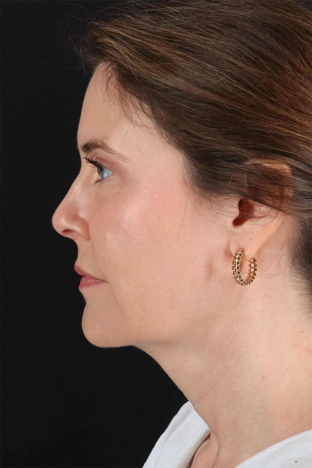 Fat Grafting To The Face Before & After Patient #11817