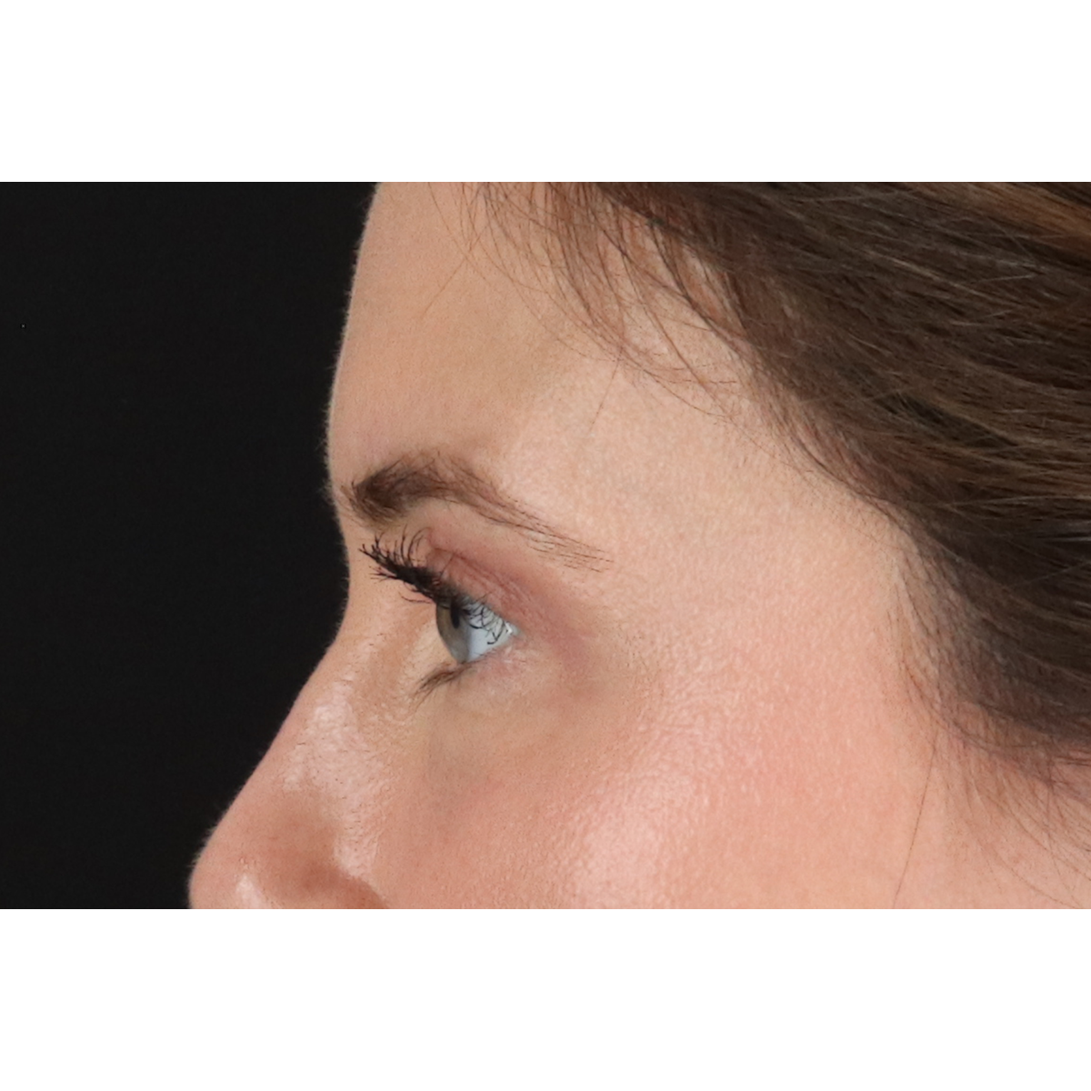 Blepharoplasty (Eyelid Surgery) Before & After Patient #11517