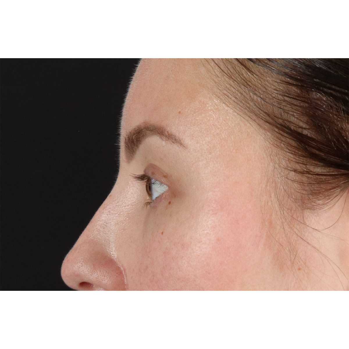 Brow Lift Before & After Patient #11657