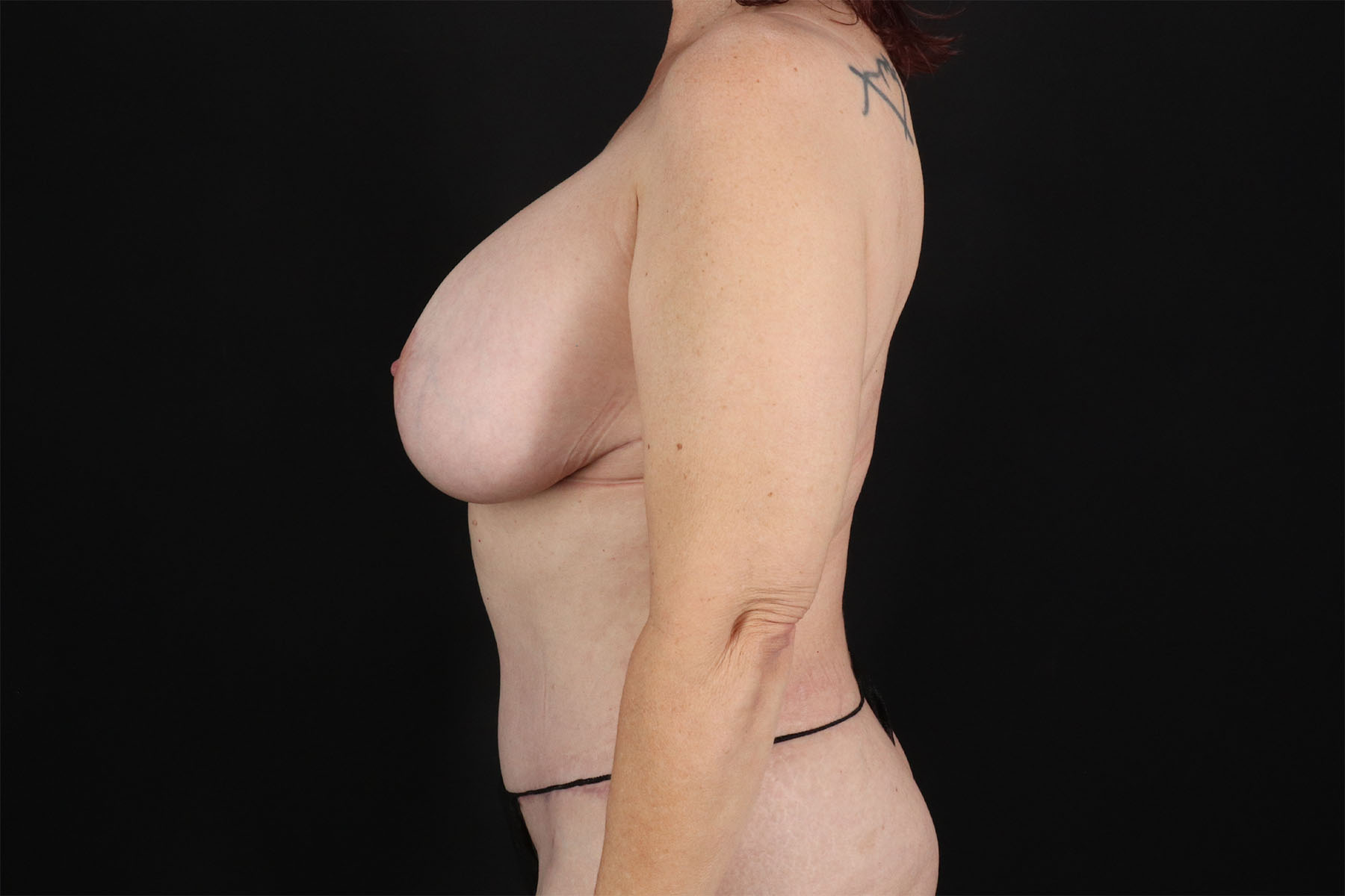 Mommy Makeover Before & After Patient #11013