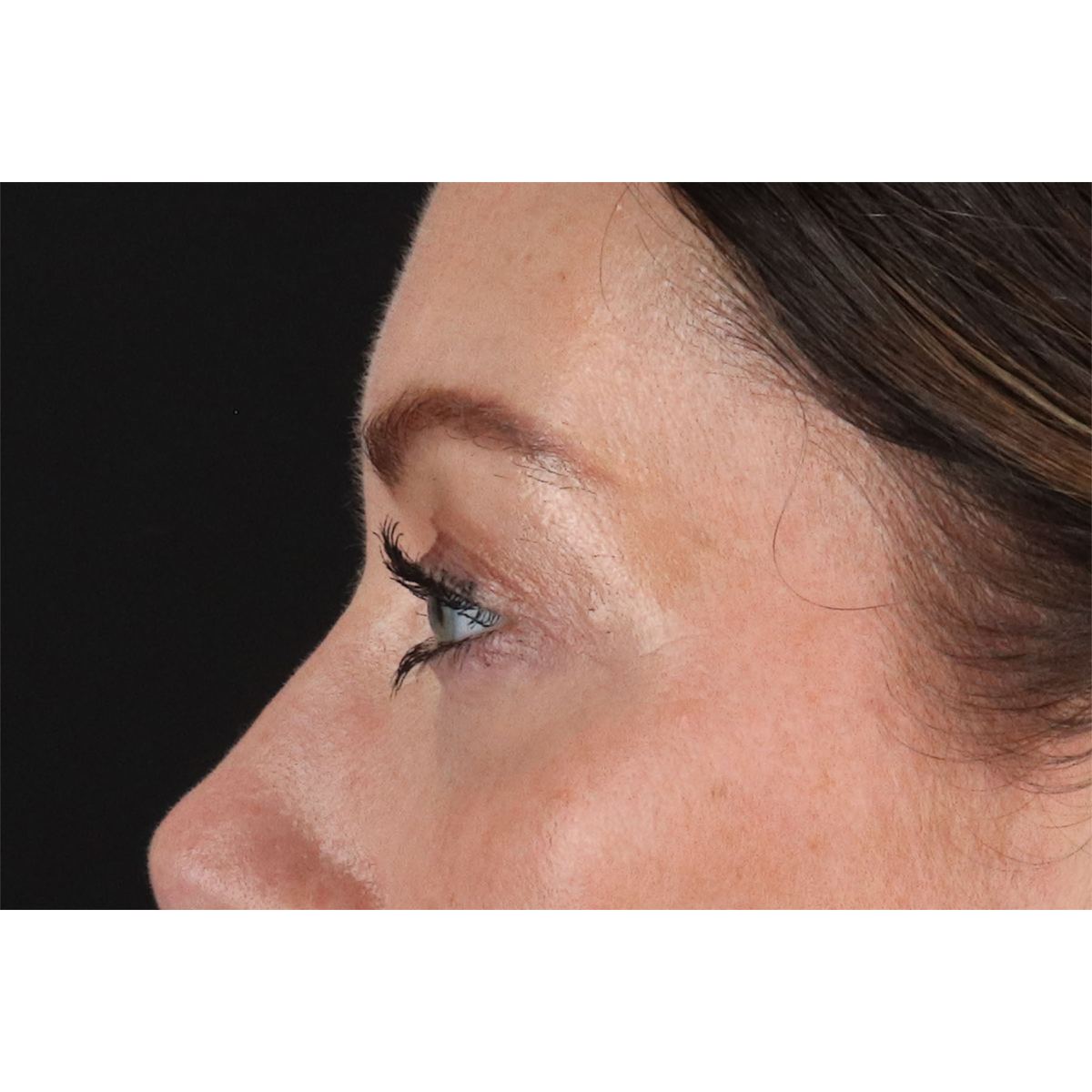 Blepharoplasty (Eyelid Surgery) Before & After Patient #11026