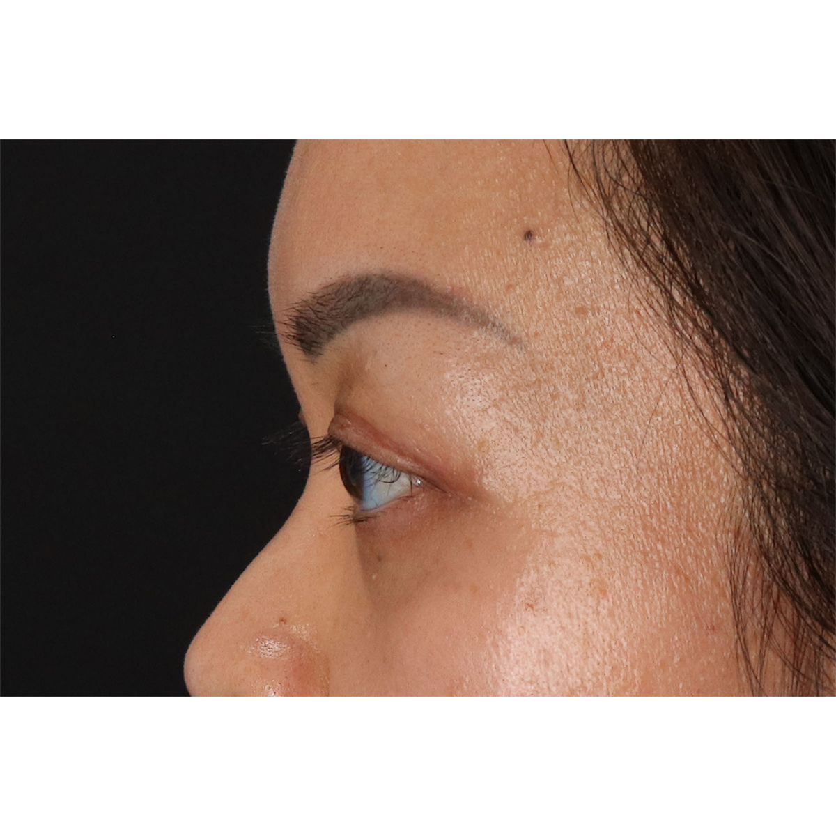 Blepharoplasty (Eyelid Surgery) Before & After Patient #11037