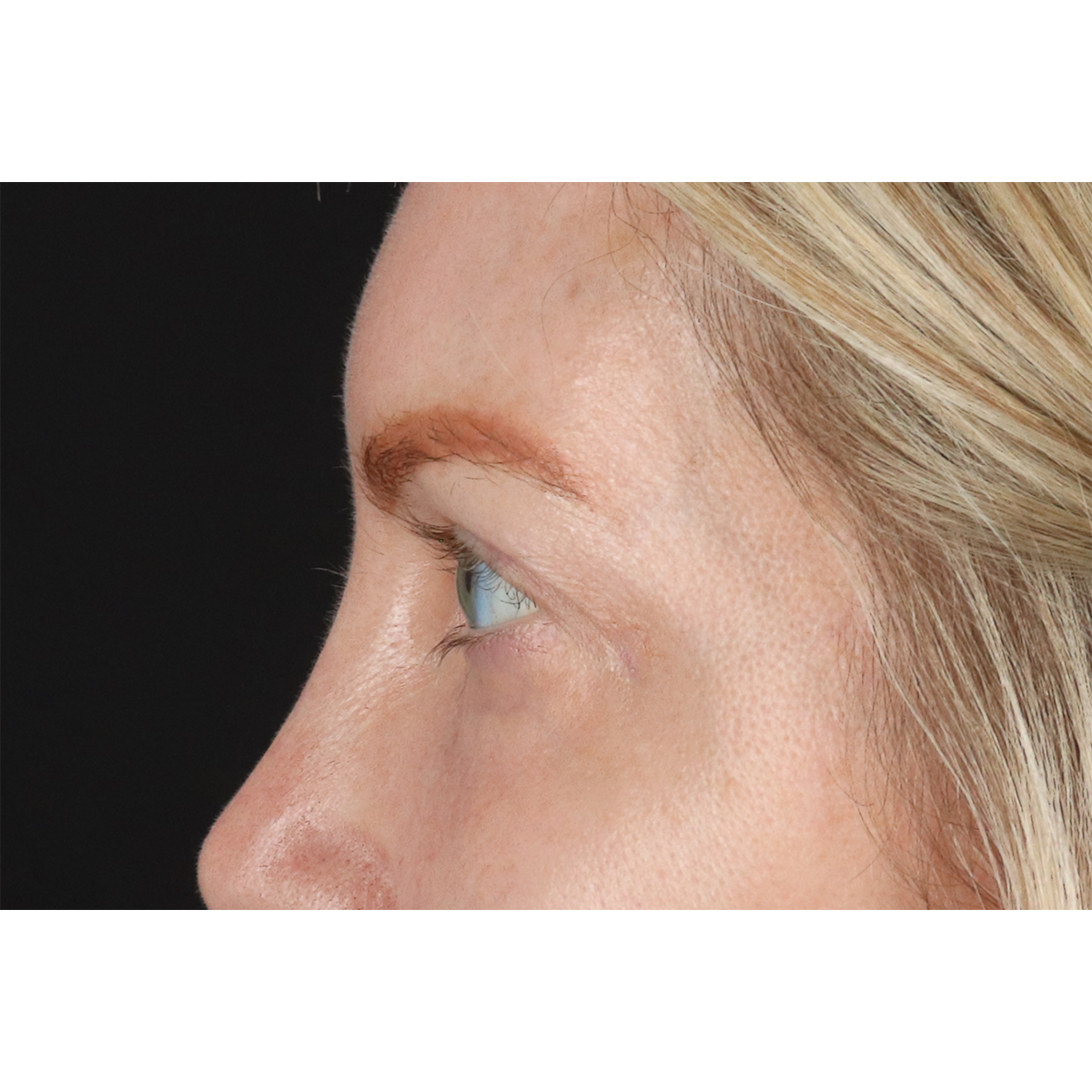 Blepharoplasty (Eyelid Surgery) Before & After Patient #11158