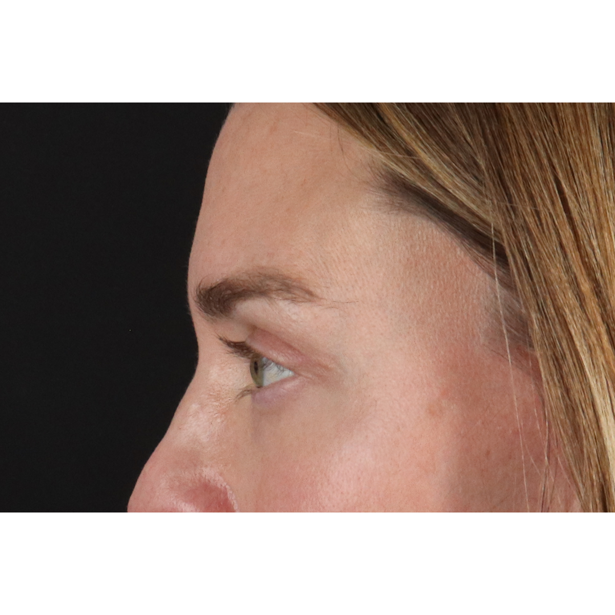 Blepharoplasty (Eyelid Surgery) Before & After Patient #11541