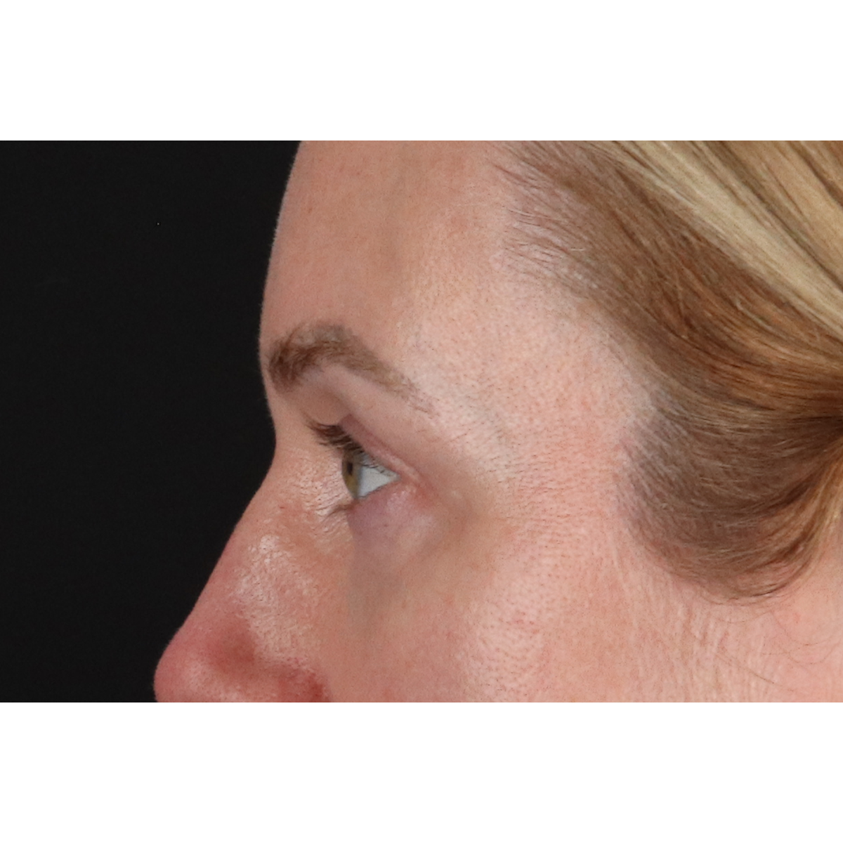 Blepharoplasty (Eyelid Surgery) Before & After Patient #11883