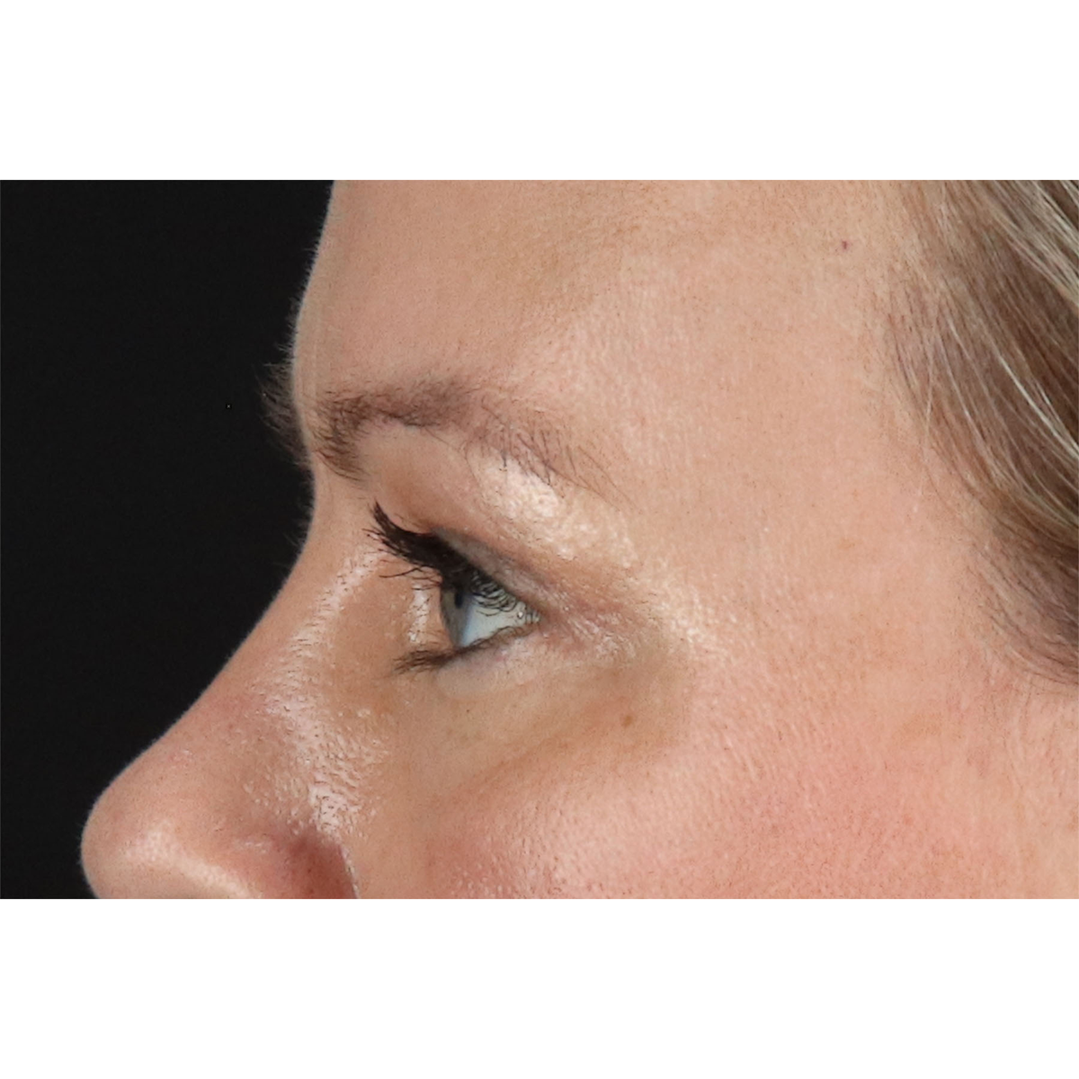 Blepharoplasty (Eyelid Surgery) Before & After Patient #11048