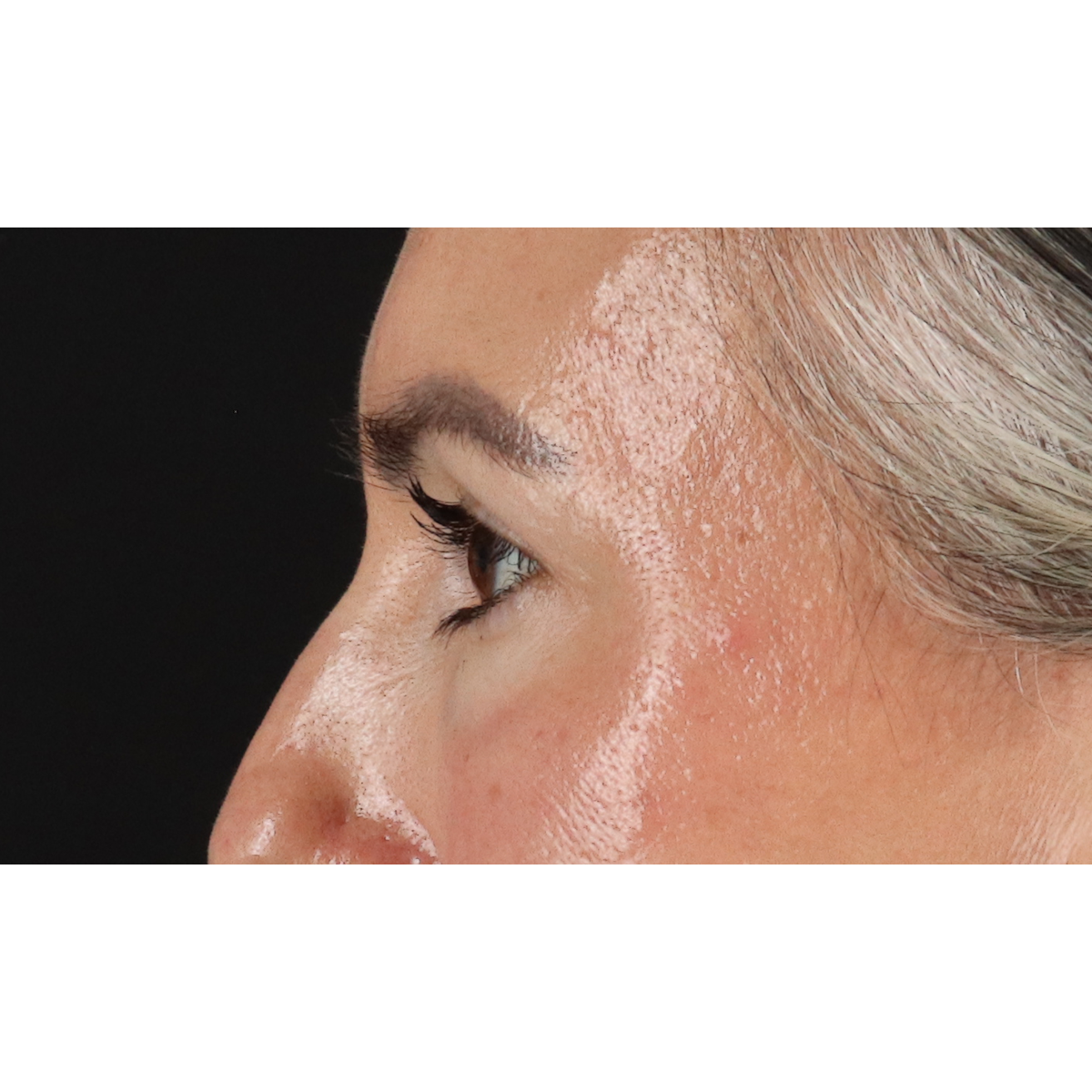 Blepharoplasty (Eyelid Surgery) Before & After Patient #11282