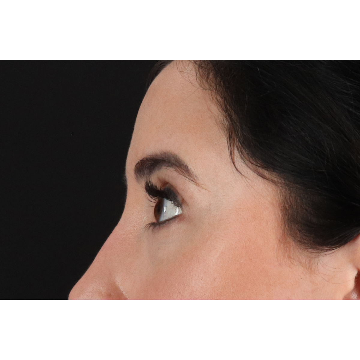 Blepharoplasty (Eyelid Surgery) Before & After Patient #11668