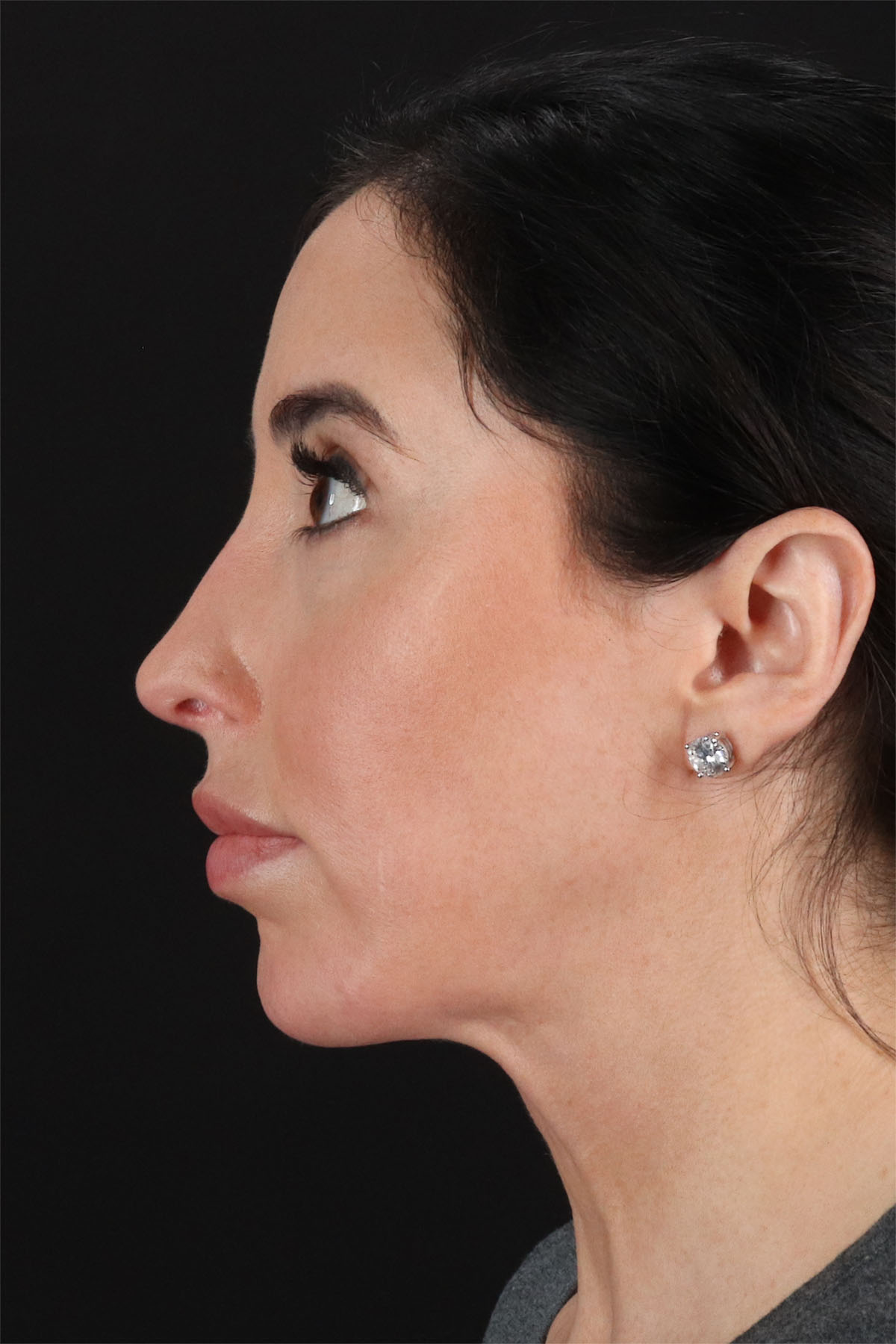 Fat Grafting To The Face Before & After Patient #11783