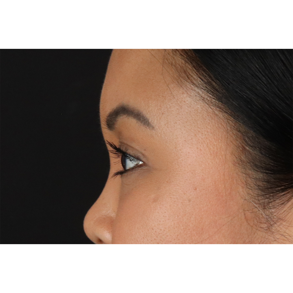 Brow Lift Before & After Patient #11646