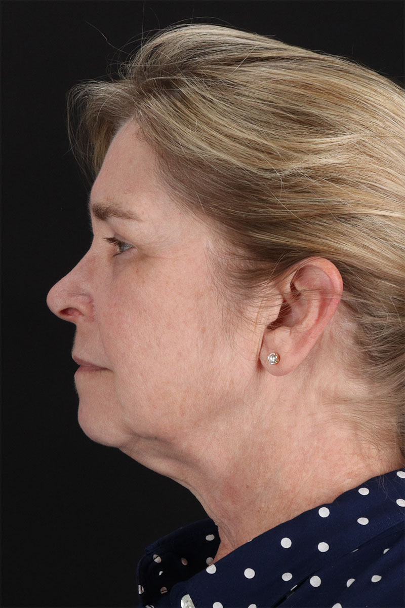 CO2 Laser Before & After Patient #11191
