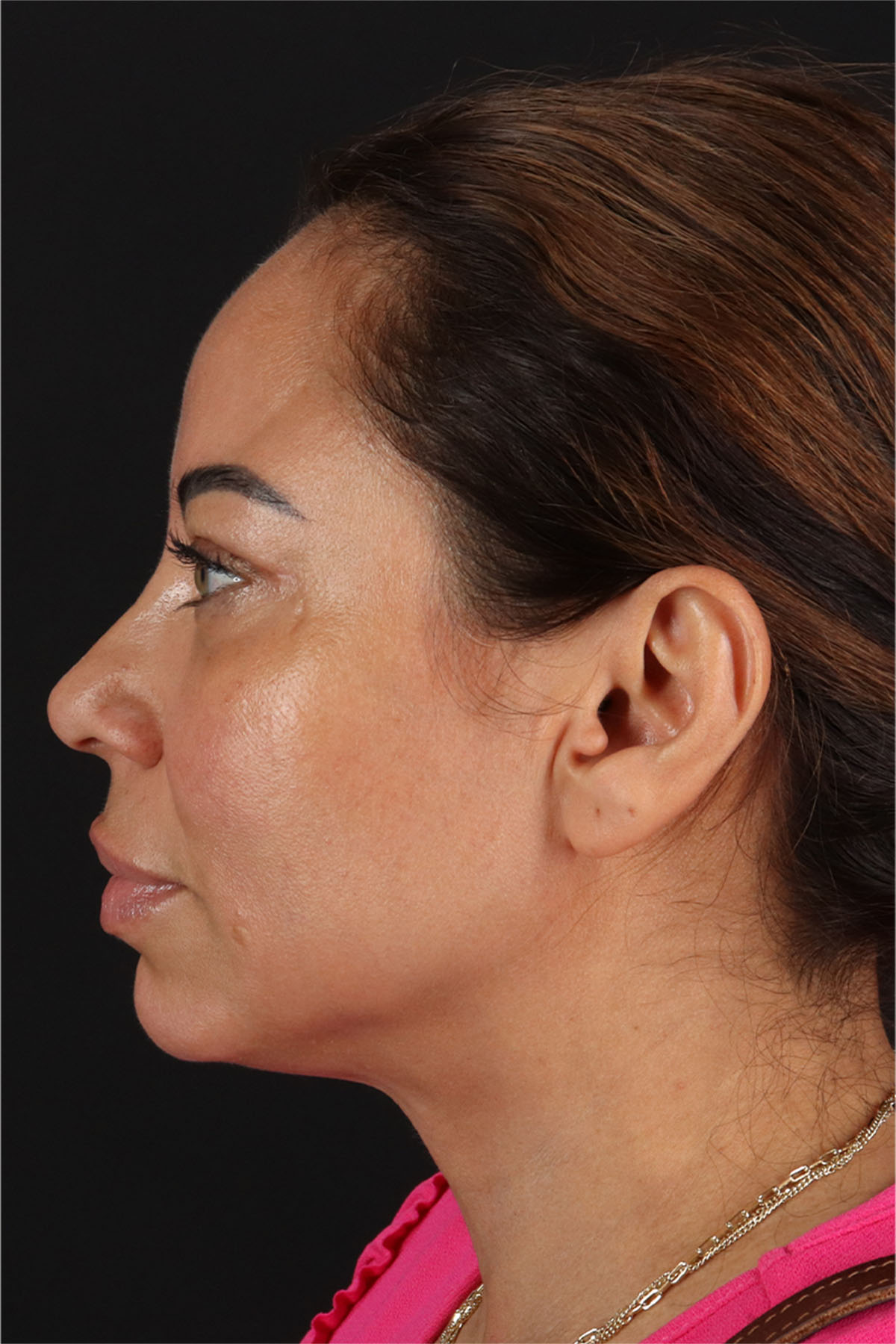 CO2 Laser Before & After Patient #11719