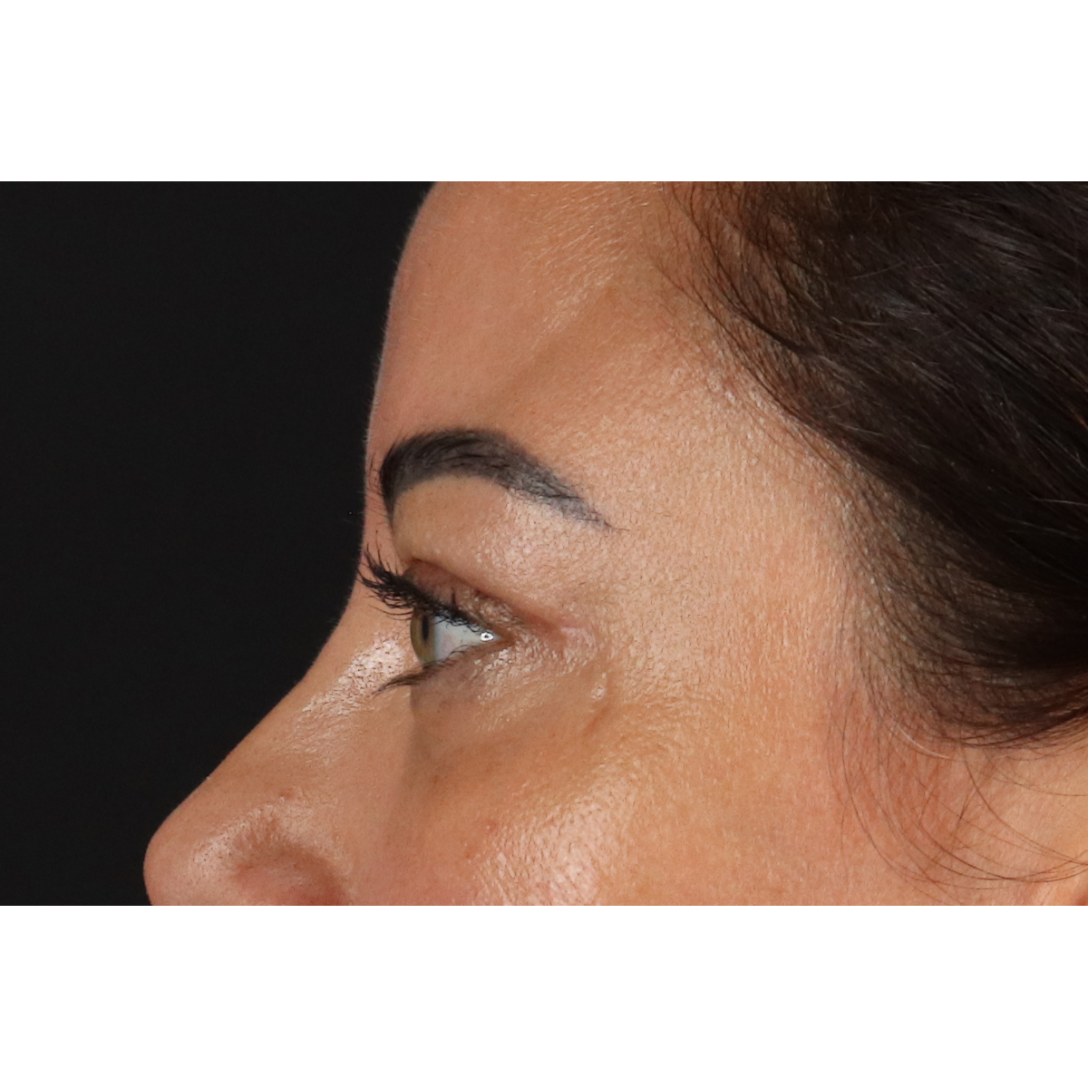 Blepharoplasty (Eyelid Surgery) Before & After Patient #11348