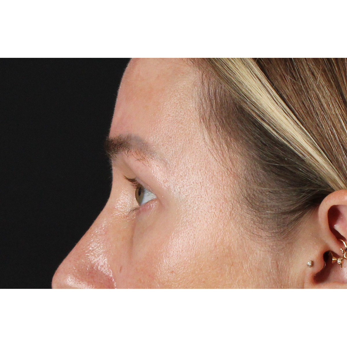 Blepharoplasty (Eyelid Surgery) Before & After Patient #11585