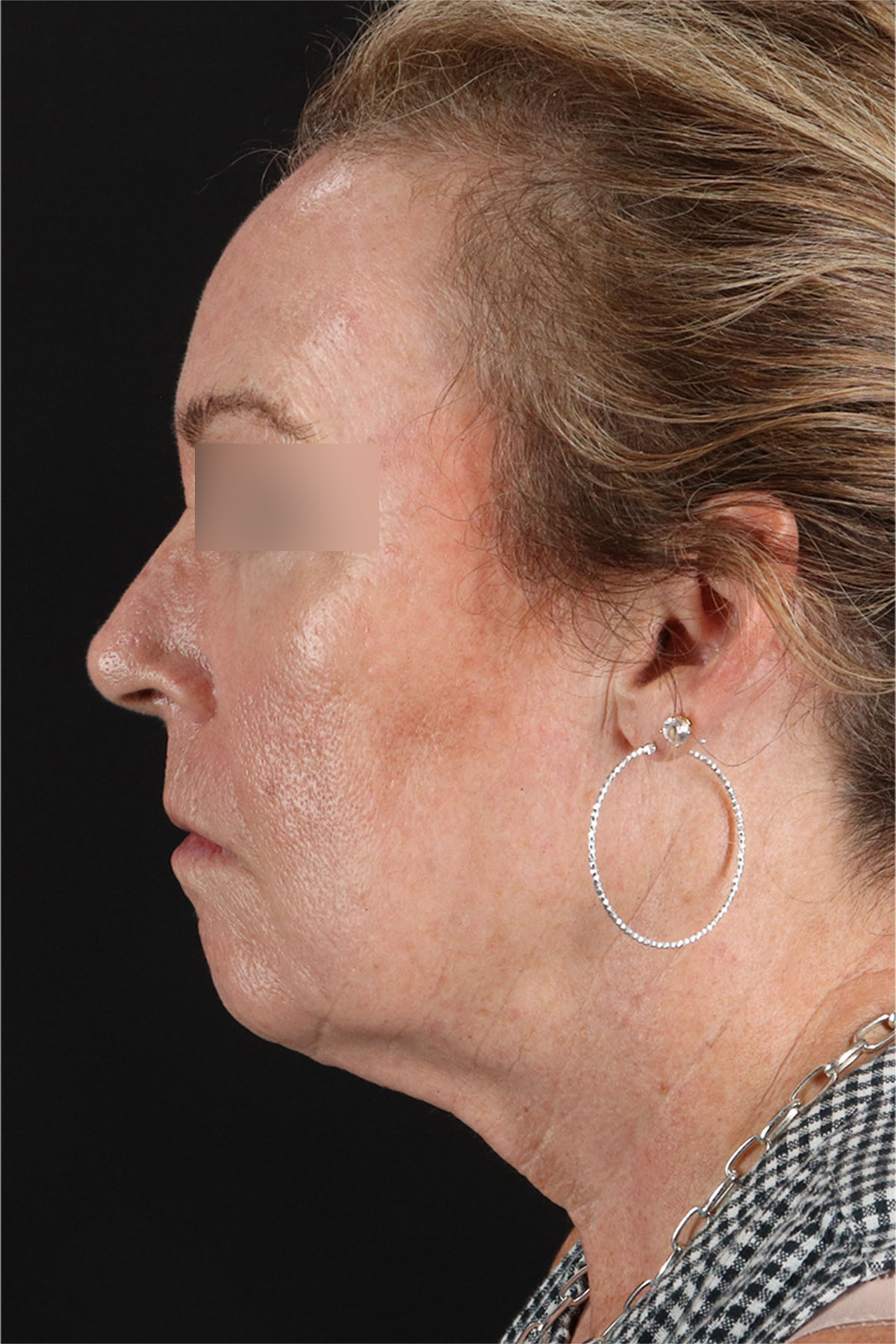 CO2 Laser Before & After Patient #11385