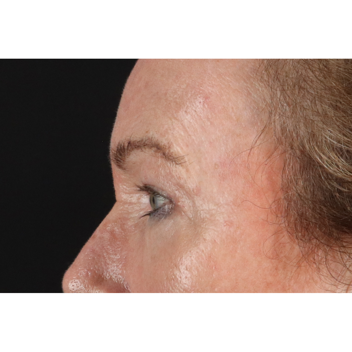 Blepharoplasty (Eyelid Surgery) Before & After Patient #11404