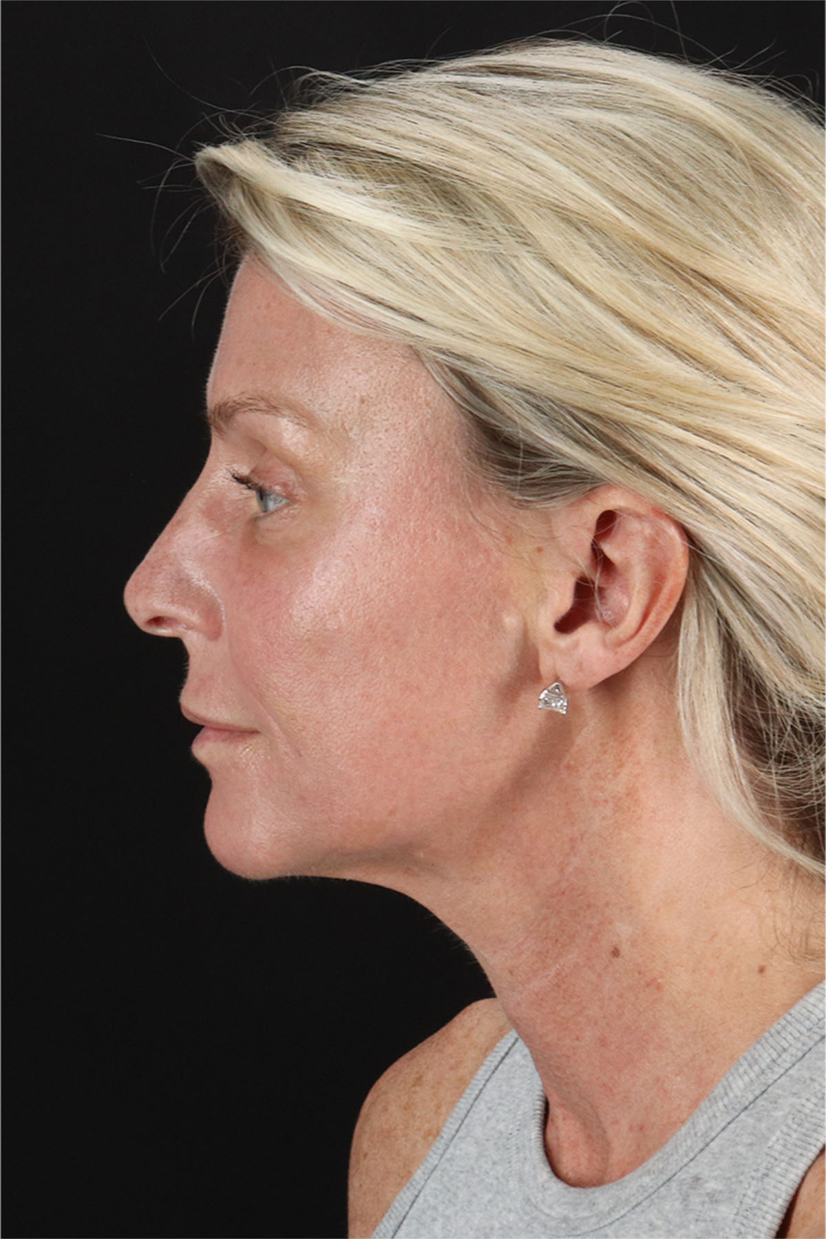 Fat Grafting To The Face Before & After Patient #11753