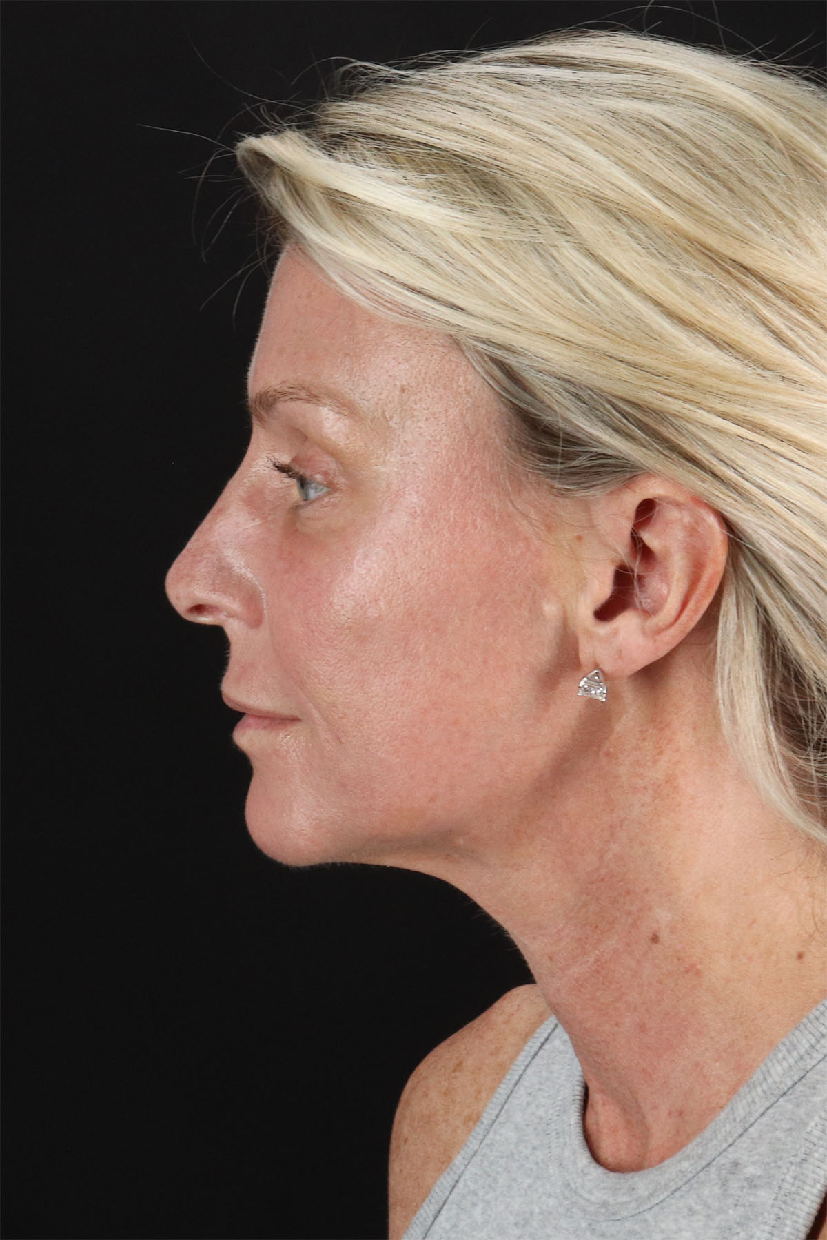 CO2 Laser Before & After Patient #11202