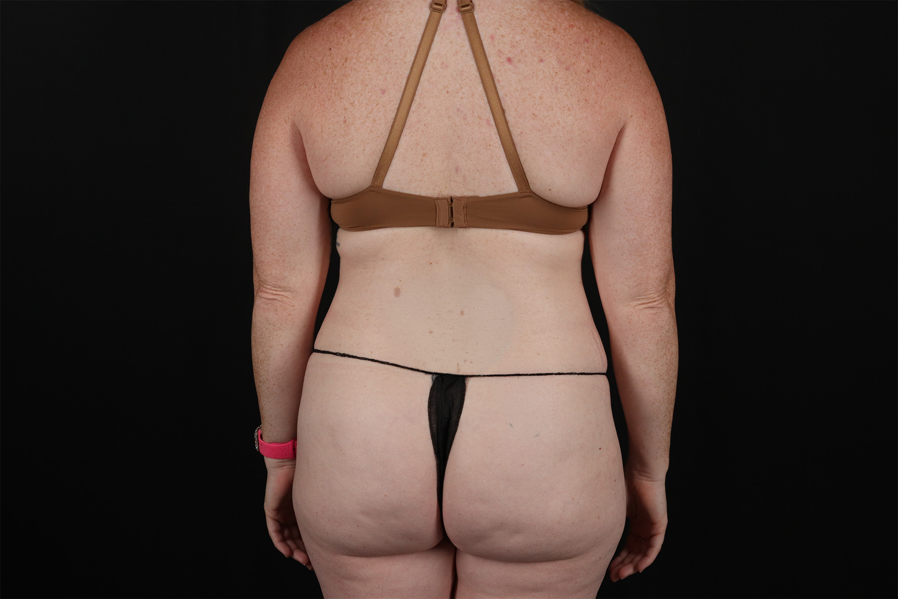 Abdominoplasty (Tummy Tuck) Before & After Patient #9980