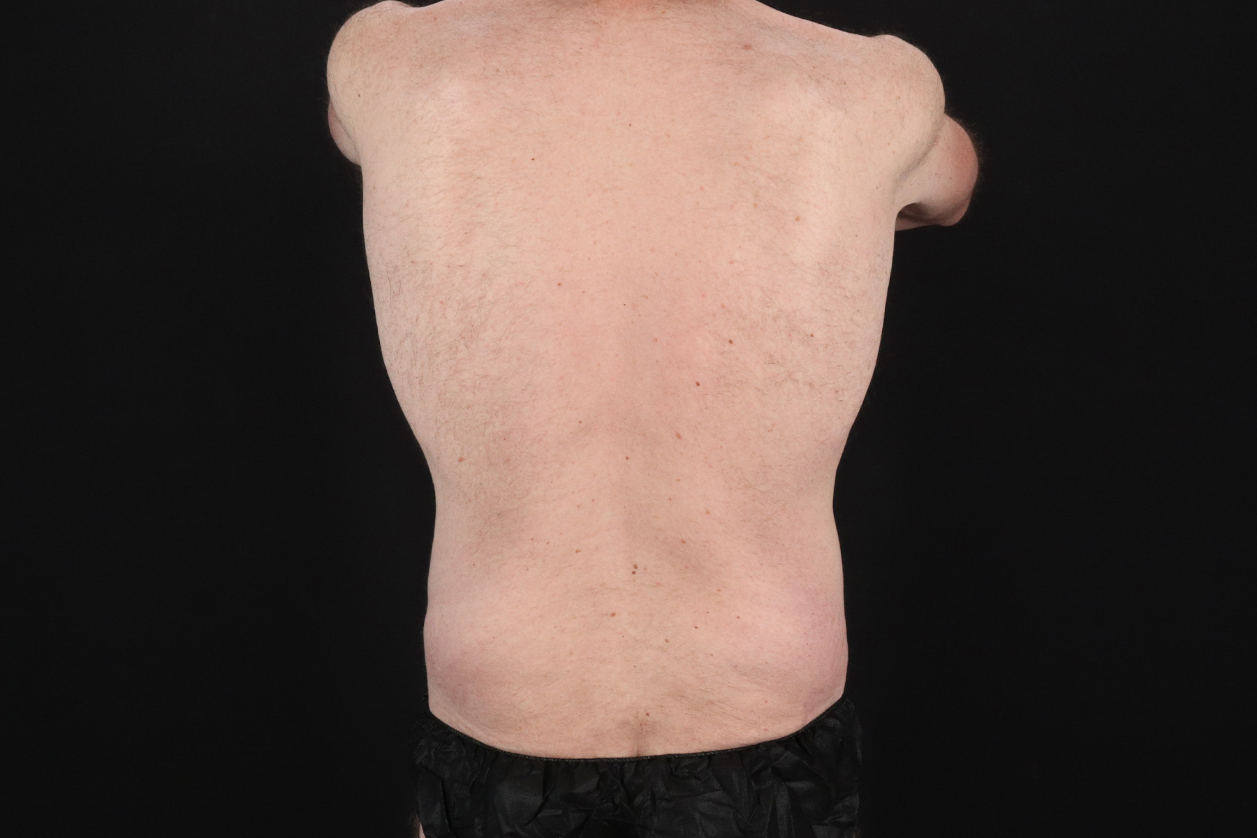Quantum RF Before & After Patient #9985