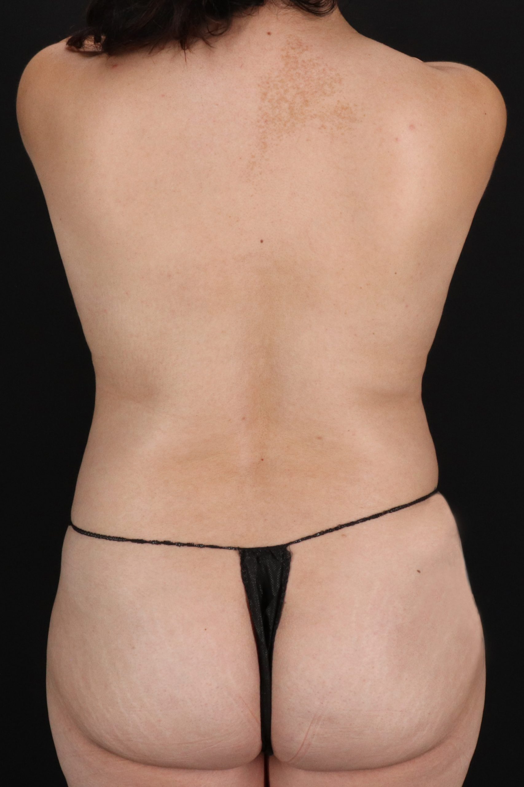 All Me Augmentation Before & After Patient #10277