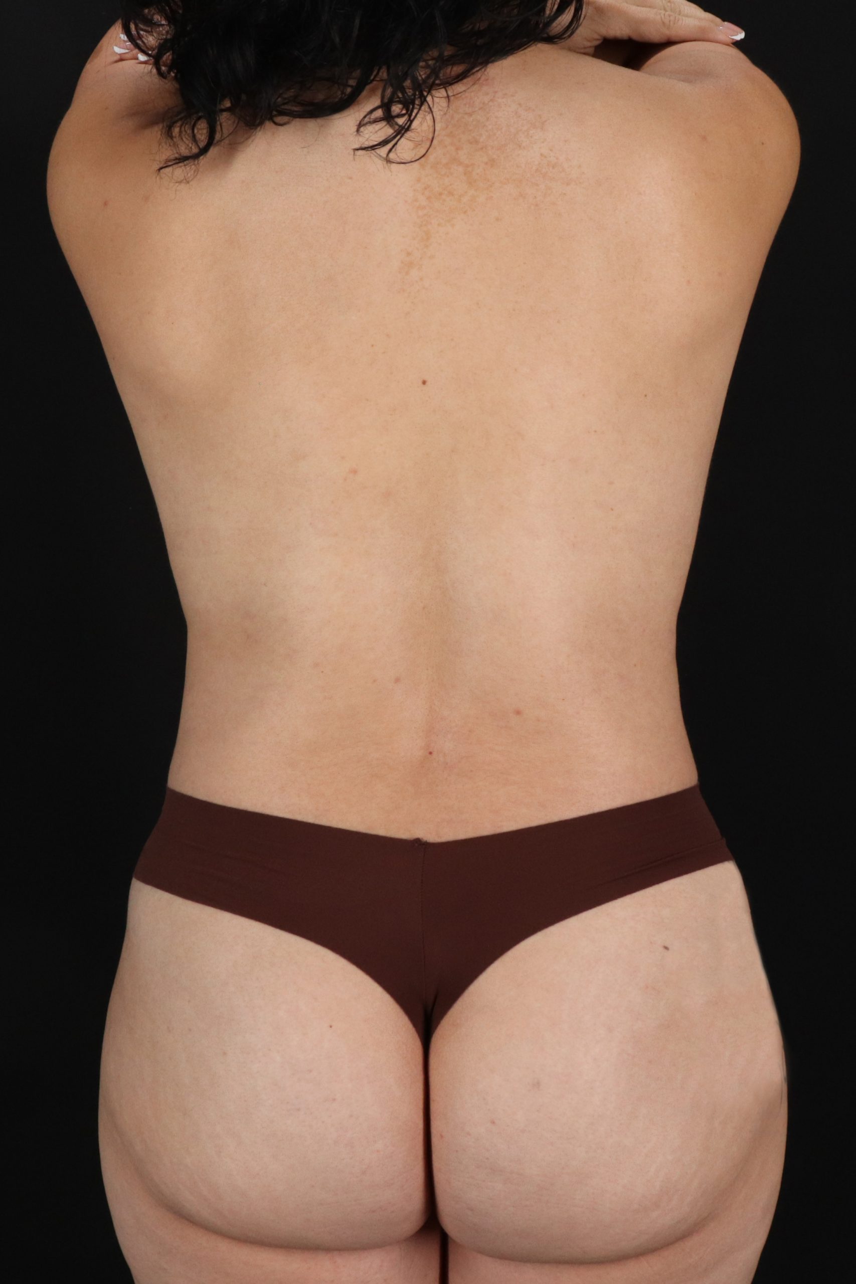 All Me Augmentation Before & After Patient #10277