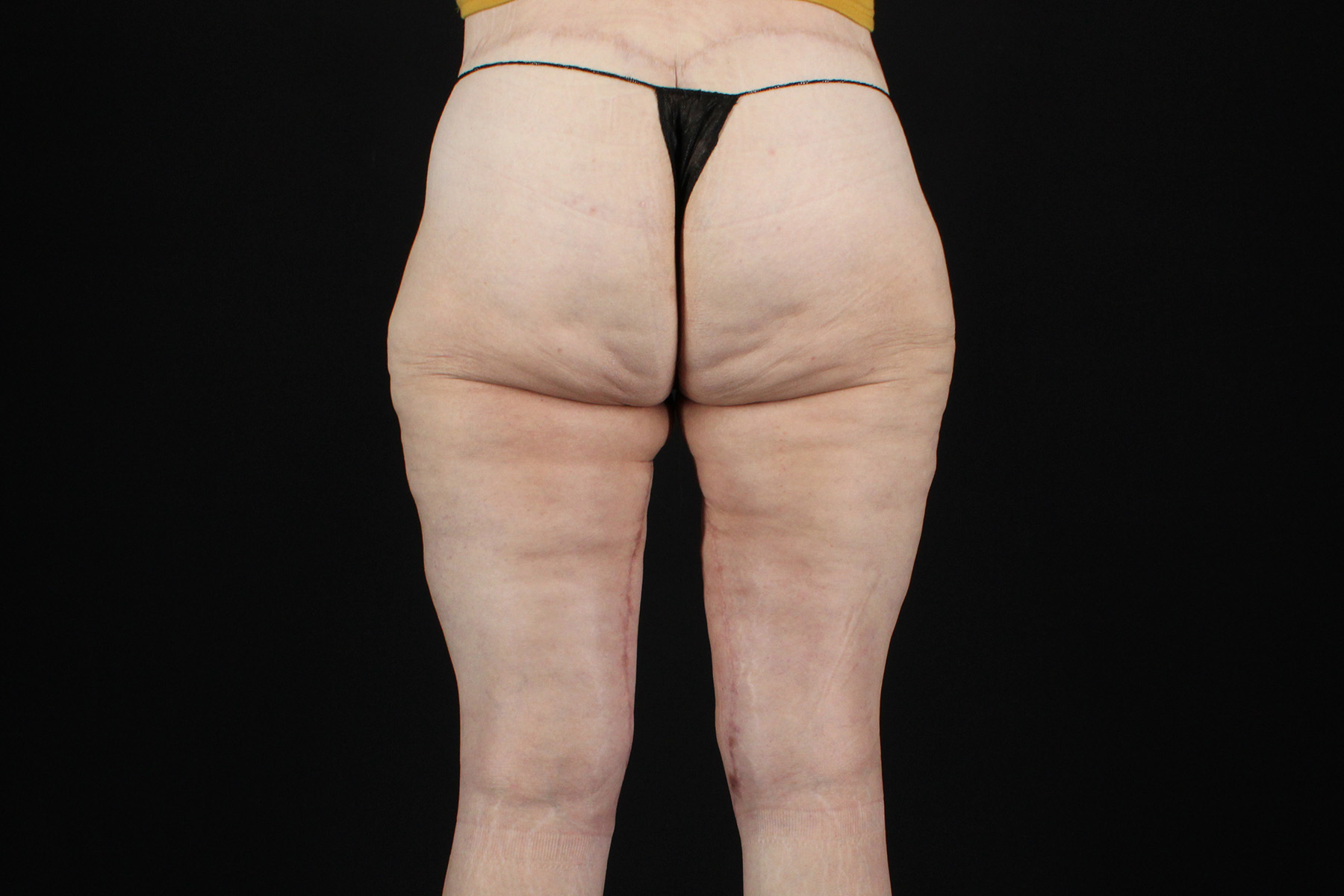 Quantum RF Before & After Patient #9984