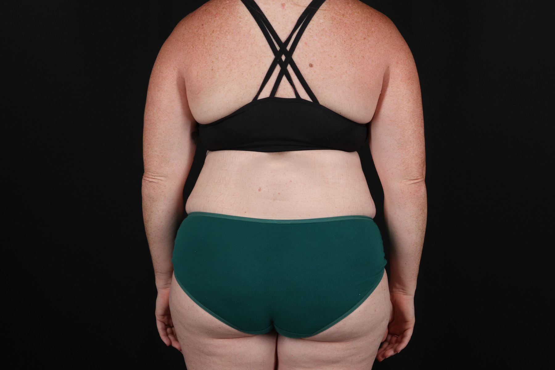 Abdominoplasty (Tummy Tuck) Before & After Patient #9980
