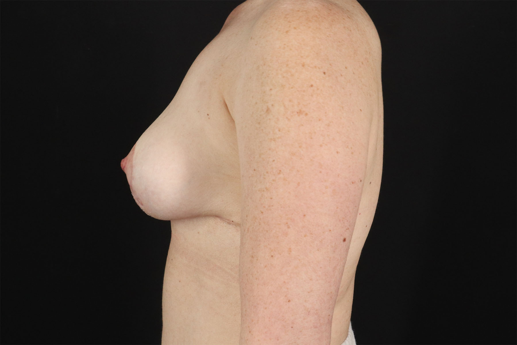Breast Lift Before & After Patient #11180