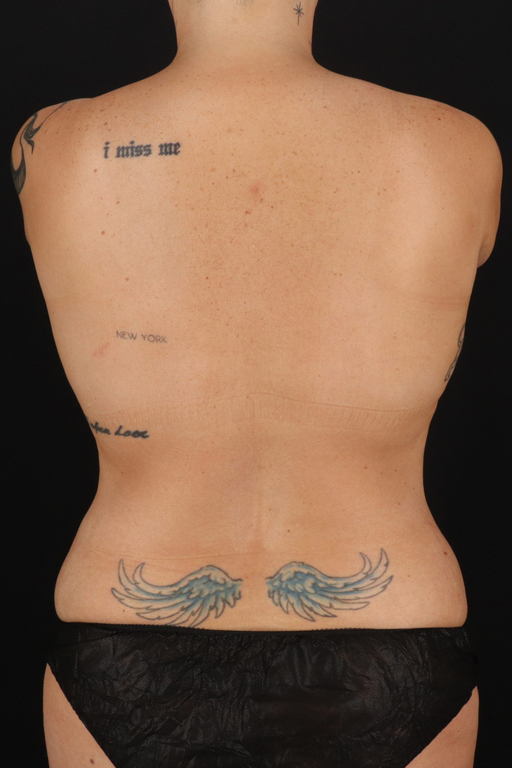 All Me Augmentation Before & After Patient #10278