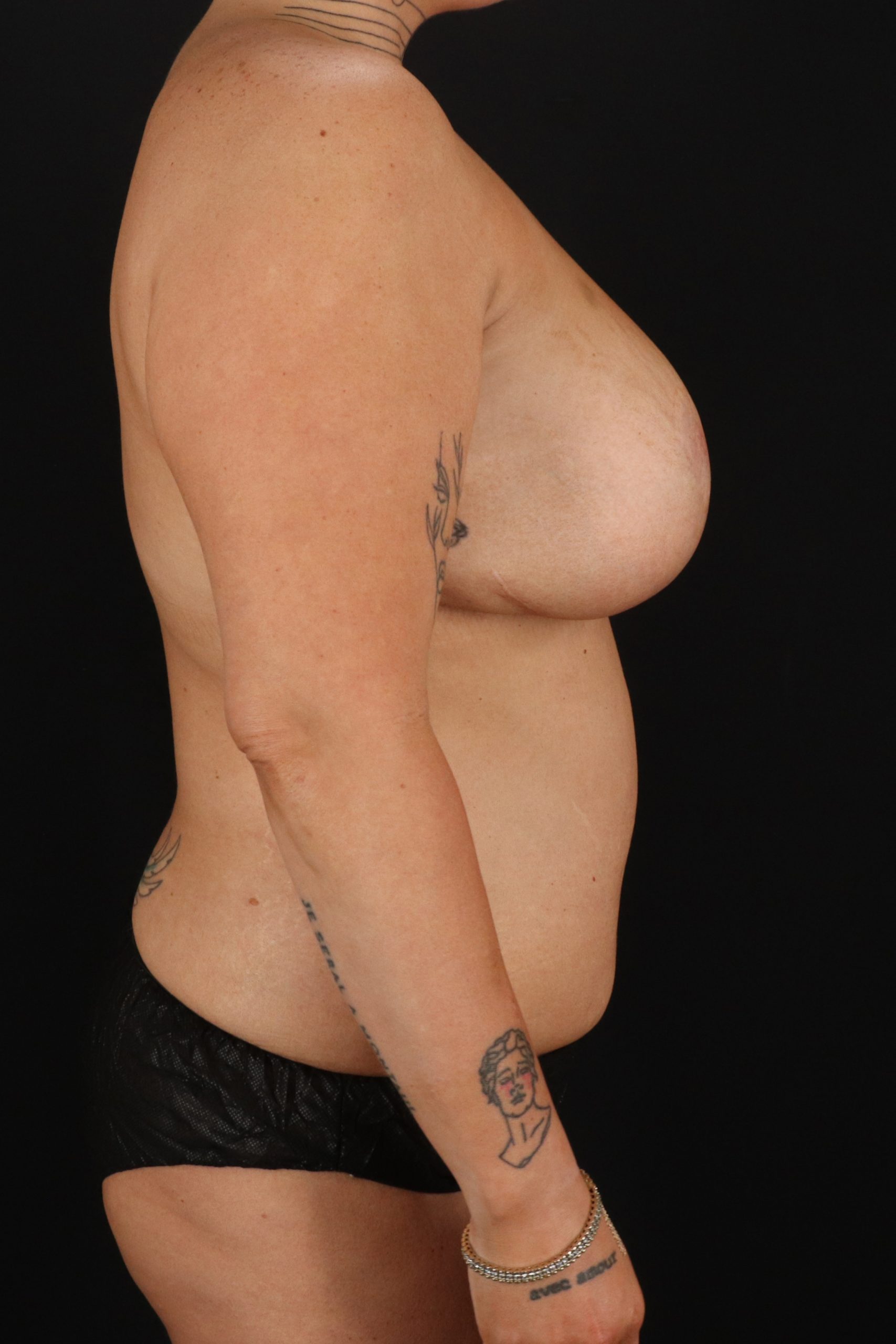 All Me Augmentation Before & After Patient #10278