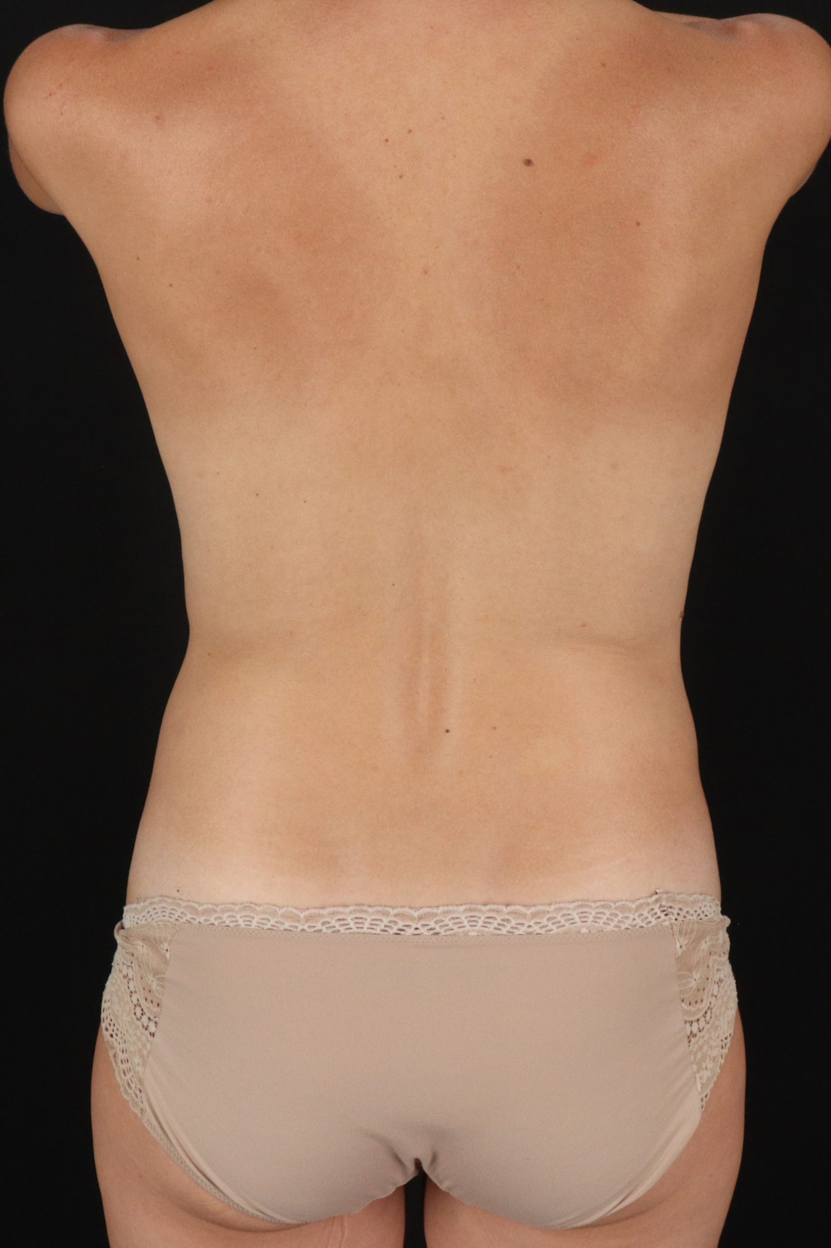 All Me Augmentation Before & After Patient #10279