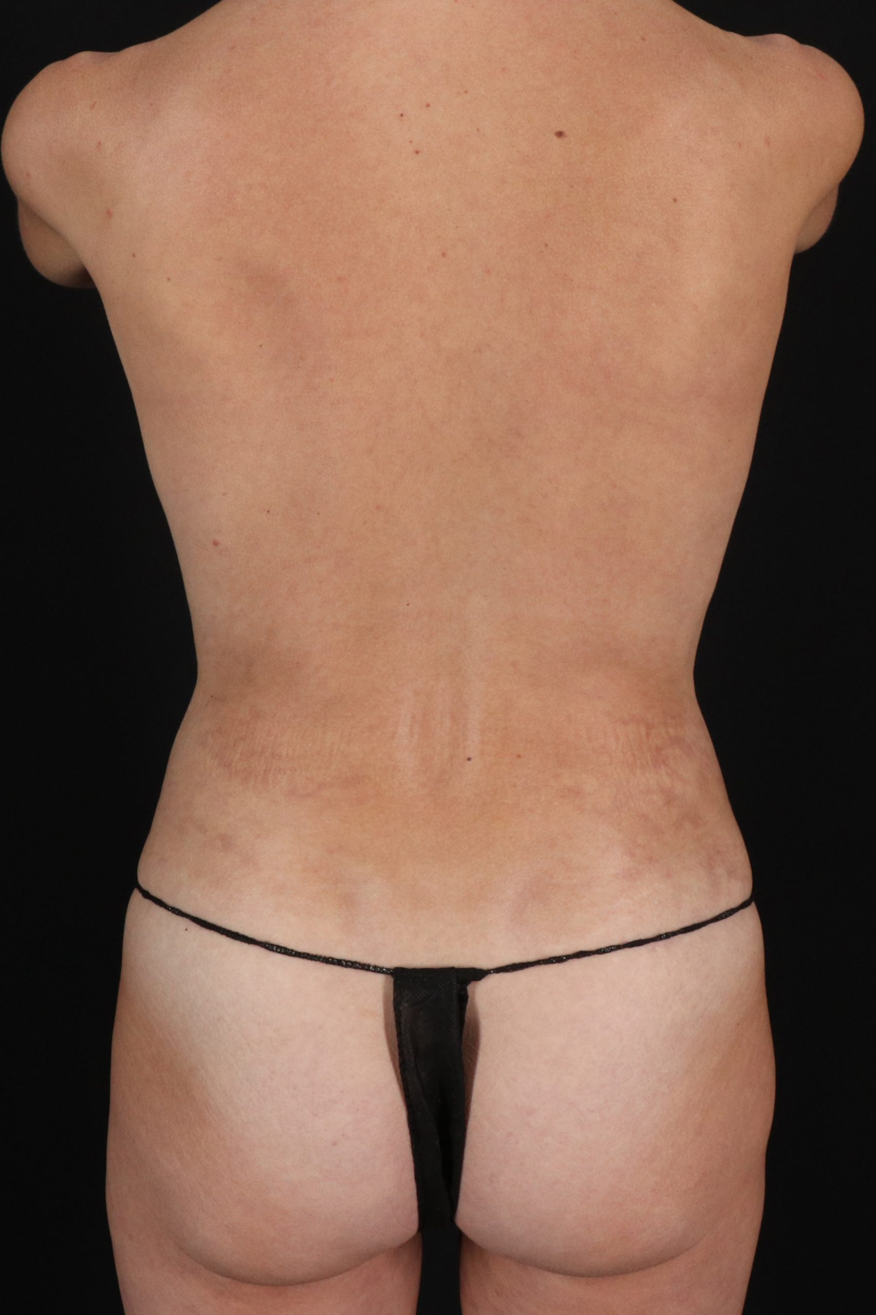All Me Augmentation Before & After Patient #10279
