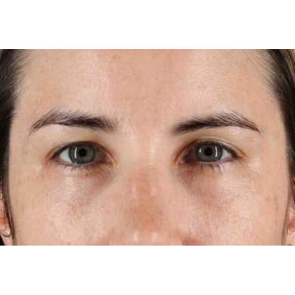 Brow Lift Before & After Patient #10826