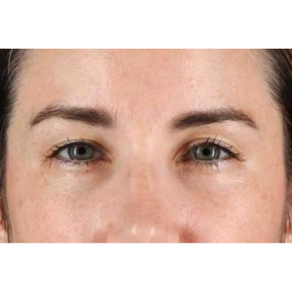 Brow Lift Before & After Patient #10826