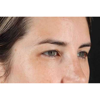 Brow Lift Before & After Patient #10826