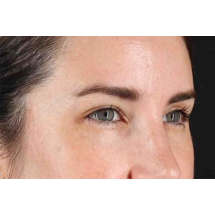 Brow Lift Before & After Patient #10826