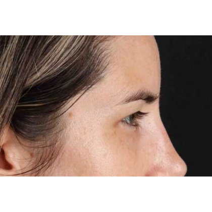 Brow Lift Before & After Patient #10826