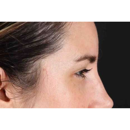 Brow Lift Before & After Patient #10826
