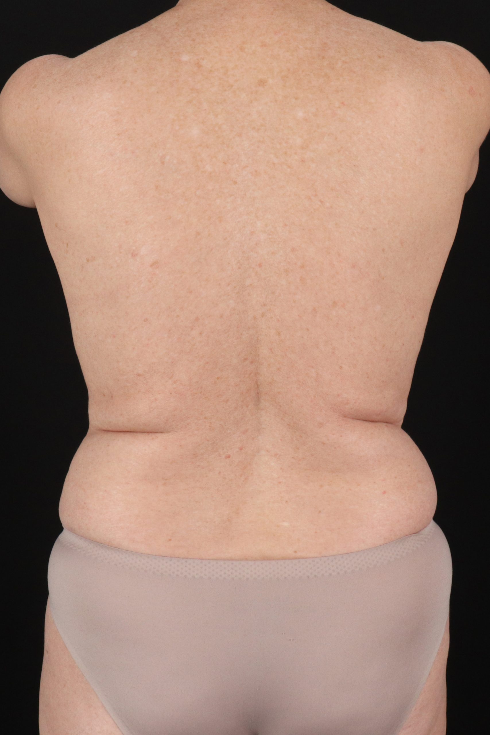 All Me Augmentation Before & After Patient #10280